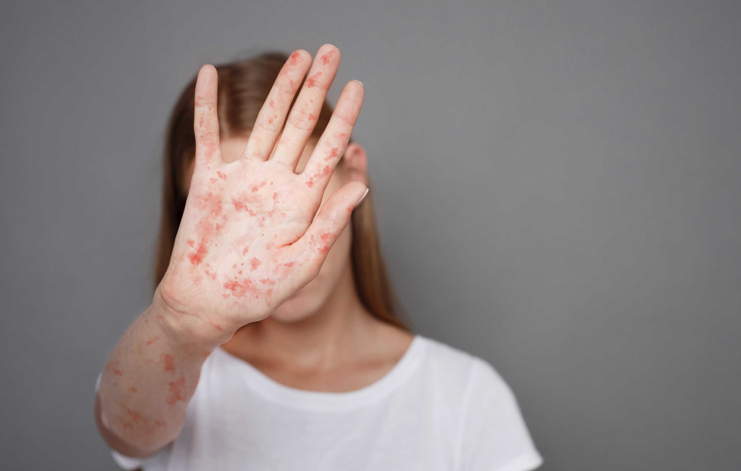 Entrevista: Brasil entra em alerta máximo por surtos de sarampo na América